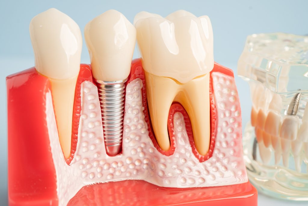 dental implants lafayette