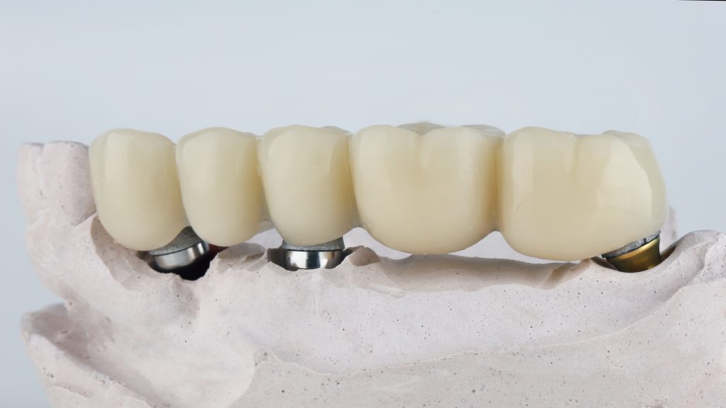 implant bridges lafayette