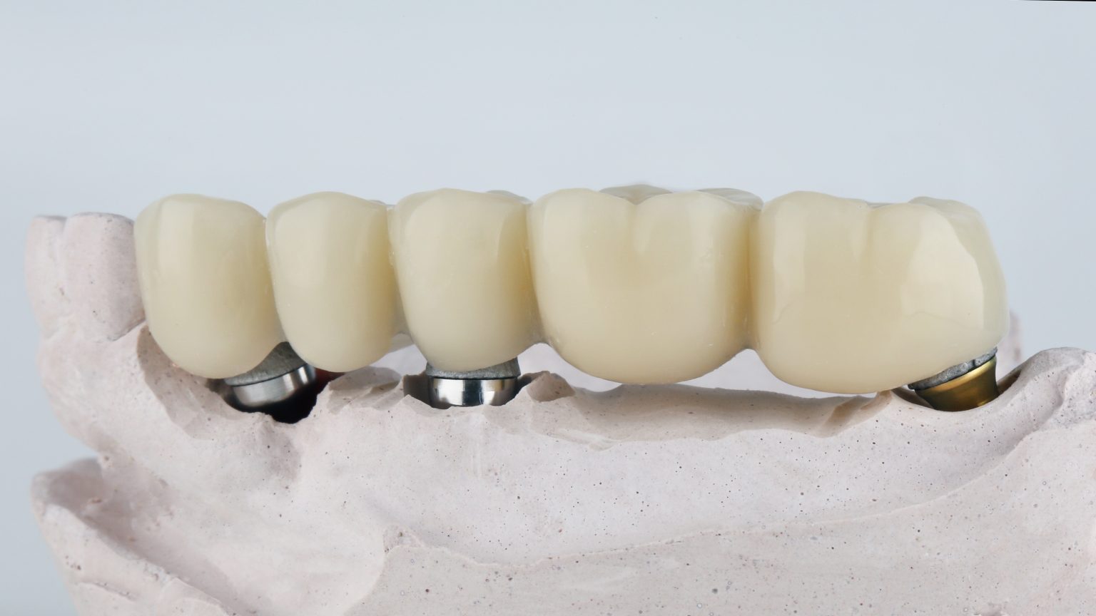 implant bridges lafayette