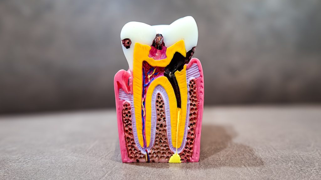 root canals lafayette