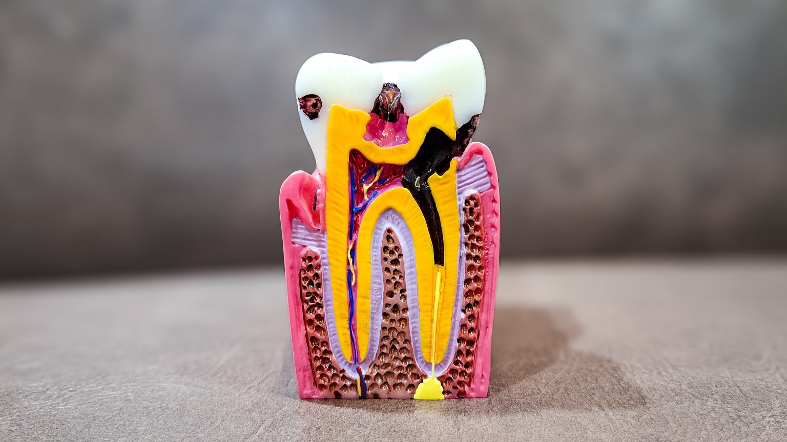 root canals lafayette